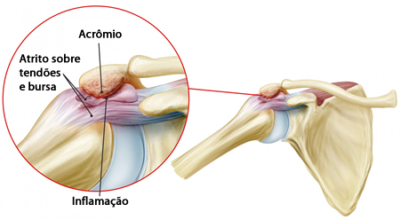 Inflamação do ombro: atrito sobre tendões e bursa