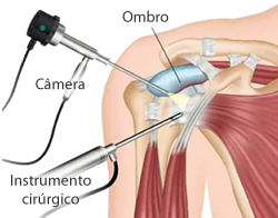 Videocirurgia do ombro, apresentando a câmera, o instrumento cirúrgico e a região do ombro.